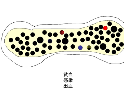 白血病の原因は　図2